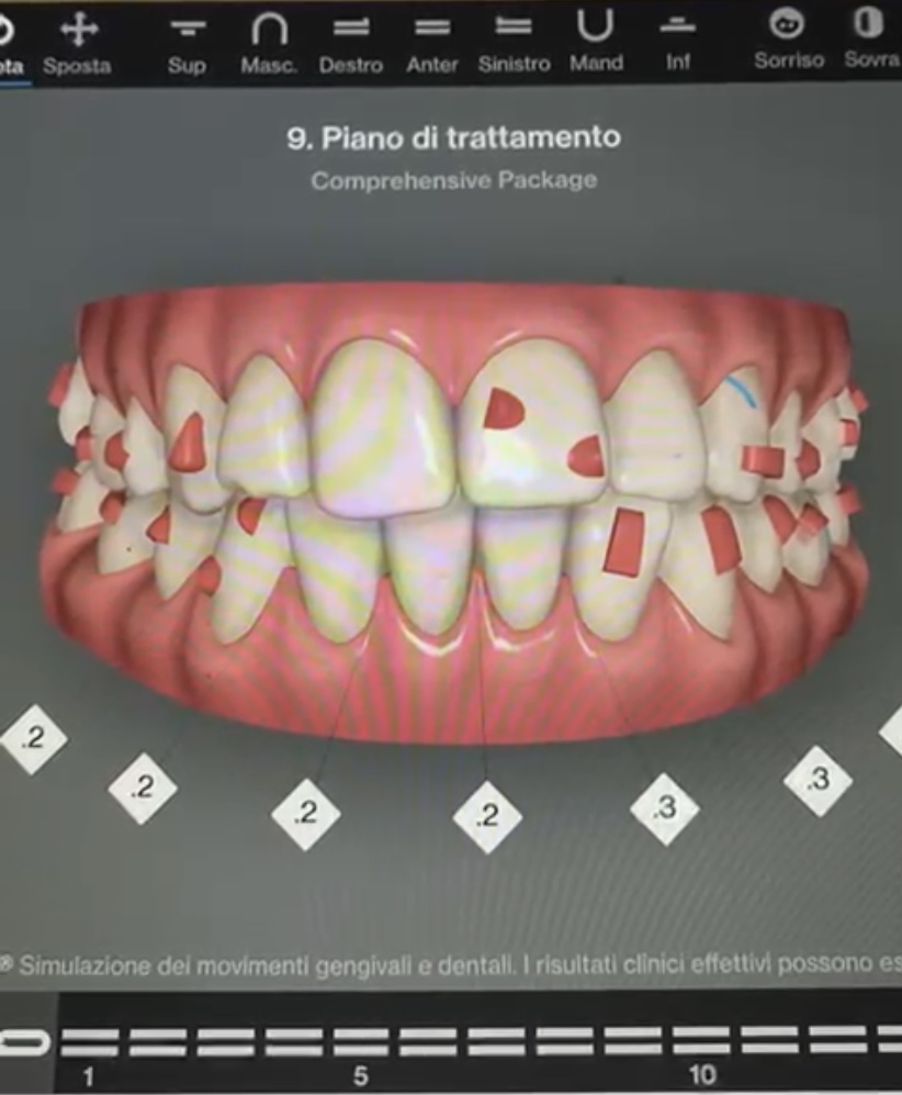 invisalign progetto